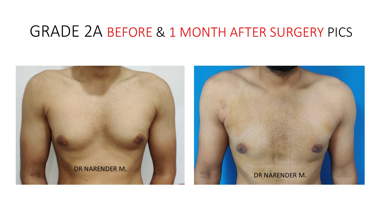 Gynecomastia Photo 1